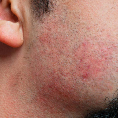 iritasi setelah cukuran